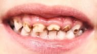 Rotten teeth (Image via Getty Images)